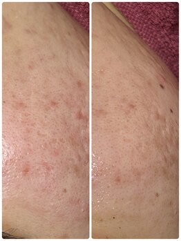 ビマリア(美-MARIA)/ハーブピーリング１回