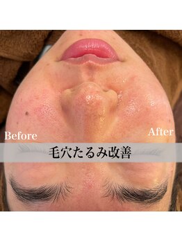 アール アンド ビューティーサロン(Ｒ＆ BeautySalon)/たるみ毛穴にアプローチ