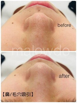 マロウド 藤枝店(malowdo)/【人気オプション】鼻の毛穴吸引