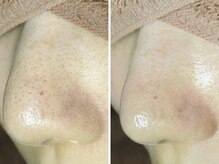 美鼻ラボ 押上 曳舟/毛穴エクストラクションプロ