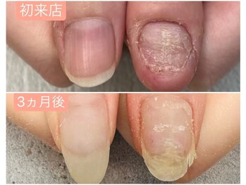 グレースレディ/伴走型の深爪矯正