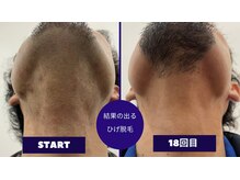 フェイシャル専門サロン サロン ド ウイッシュ/メンズひげ脱毛