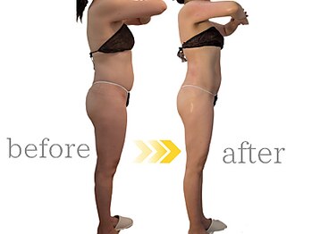 ウィッシュ(WISH)/セルライトゼロ痩身