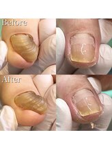 巻き爪補正店 北千住店/施術【変形爪再生補正】