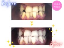 エクシアホワイト 広島袋町店/ホワイトニングビフォーアフター