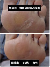 巻き爪じゅん 千葉駅前店/ 魚の目と角質専門施術で快適に