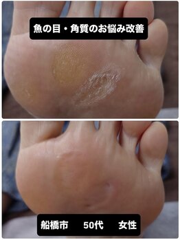 巻き爪じゅん 千葉駅前店/ 魚の目と角質専門施術で快適に