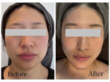 なごみ/小顔◆脂肪分解液レッドショット