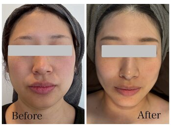 なごみ/小顔◆脂肪分解液レッドショット