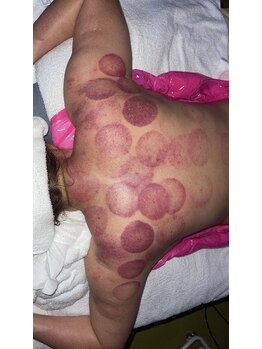 中国整体 らくらく堂/温熱療法吸い玉デトックス