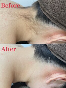 ミース 越谷店/うなじ矯正●Before、After