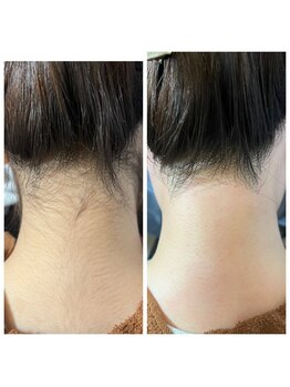 リネン(Lien)/うなじwax脱毛