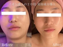 ミスティア(mistia)/フェイシャルエステ 顔8回