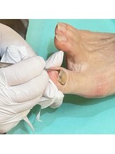 巻き爪補正店 鎌倉大船店/2.ゴミ・角質を取り除きます。