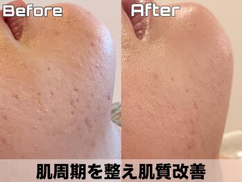 ヴィオール 名古屋栄店(VIOR)/ハーブピーリング