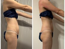 フュース(Futh)/1回の効果/マシン痩身