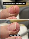 陥入爪の痛み改善の施術!