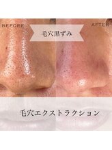 メンズプシュケ(men's PSYCHE)/毛穴洗浄