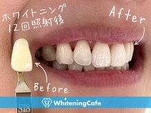 ホワイトニングカフェ 仙台店(WhiteningCafe)/☆歯のホワイトニング施術写真☆