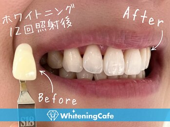 ホワイトニングカフェ 仙台店(WhiteningCafe)/☆歯のホワイトニング施術写真☆
