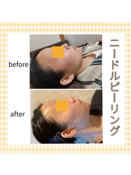 望月整体院/マイクロニードルピーリング