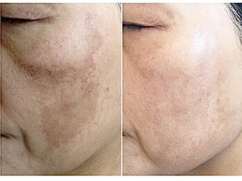 パルファンカルム 駅西本町店/ピュアレチノールの威力!