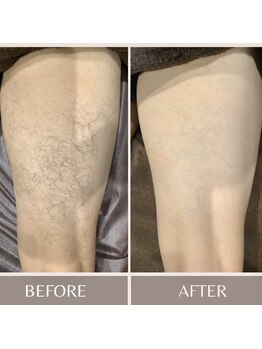 アネラ 燕三条/メンズ脱毛