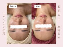 ルア(LuA.)/ホームケアで肌荒れ改善◎