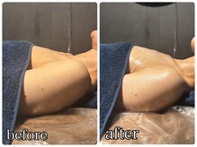 リルマコ/バスト症例写真