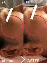 ビシル(Bishiru.)/【シミケア症例写真】２ヶ月