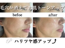 パールホワイトニングサロン 大和店の雰囲気(シミケアから5日後に!劇的変化シミ改善/ホワイトニグケア)