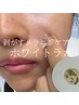 【ホワイトラボ】最新美白シミスポットケア/当日施術OK　カウンセリング 0円