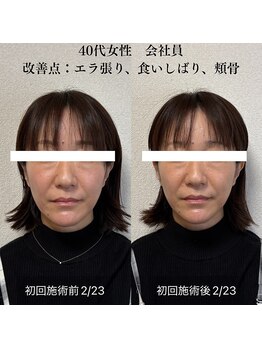 ザ リフト カドモリ 鹿児島 霧島(The Lift KADOMORI)/40代女性/エラ張り、頬骨