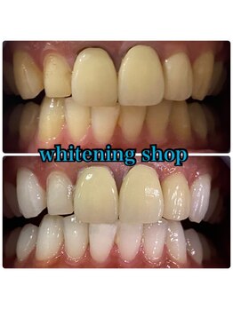 ホワイトニングショップ 三田店/before after