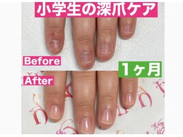 【ハンド】深爪矯正