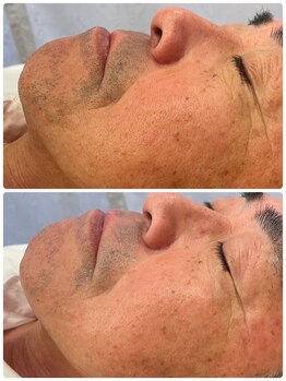 スリーズララ(Cerise LaLa)/毎日の髭剃りが楽になる！