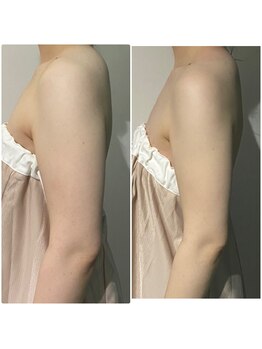 OBS/二の腕ほっそり・ブライダル