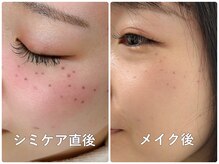 ラウレア(LAULEA)の雰囲気（シミケア直後/メイク後(シミ改善/美白・シミケア/美肌/肌質改善)）