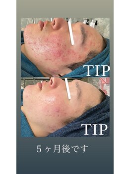 ニコサロン(nico salon)/ニキビケア