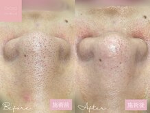 ミュー 名駅店(mieux)の雰囲気（超音波毛穴洗浄で汚れがごっそり！頑固な毛穴汚れでお悩みの方に）