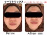《サーマトリックス》毛穴・凸凹肌・たるみ改善・小顔・引締め☆選べる3箇所