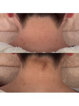 アンク(ankh.)/施術例