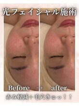 フィズ 海老名店(FIS)/光フェイシャル