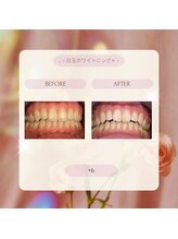 プラスビー 2号店(+b)/ホワイトニングビフォーアフター