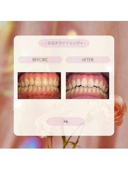 プラスビー 2号店(+b)/ホワイトニングビフォーアフター