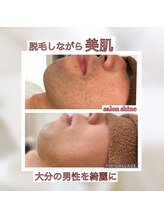 サロンシャイン(Salon Shine)/ヒゲ脱毛経過３０代後半男性