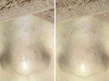 美鼻ラボ 押上 曳舟/結果の出る毛穴ケアで好評☆