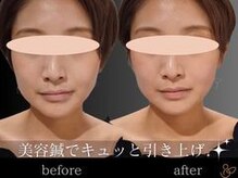 チョコバリ 渋谷店(chocobari)/小顔×リフトアップ(美容鍼)20代