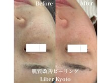 リベルキョウト 京都駅前店(Liber Kyoto)/肌質改善ピーリング