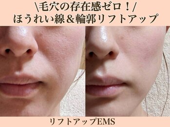 ラーナ(Lana)/リフトアップEMS　BEFORE→AFTER